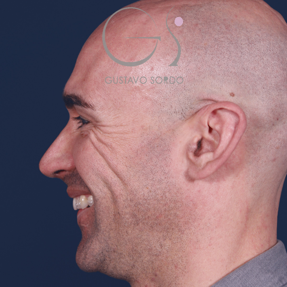 Rinoplastia ultrasónica en hombre con septoplastia y turbinoplastia, perfil izquierdo sonriendo, a los 6 meses de la operación