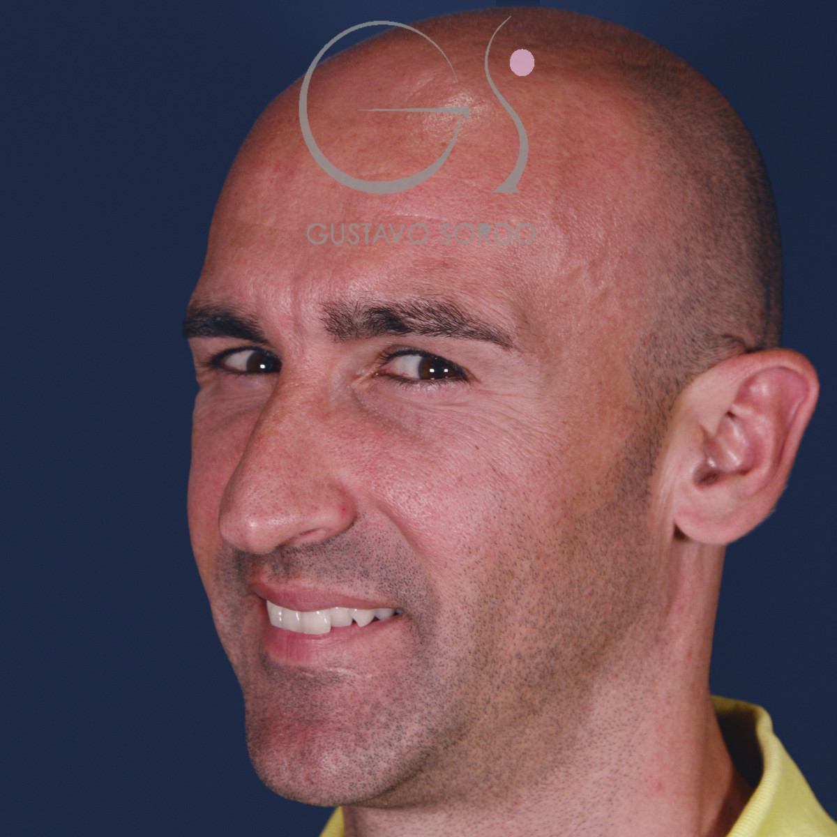 Rinoplastia ultrasónica en hombre con septoplastia y turbinoplastia, semiperfil izquierdo, antes de la operación