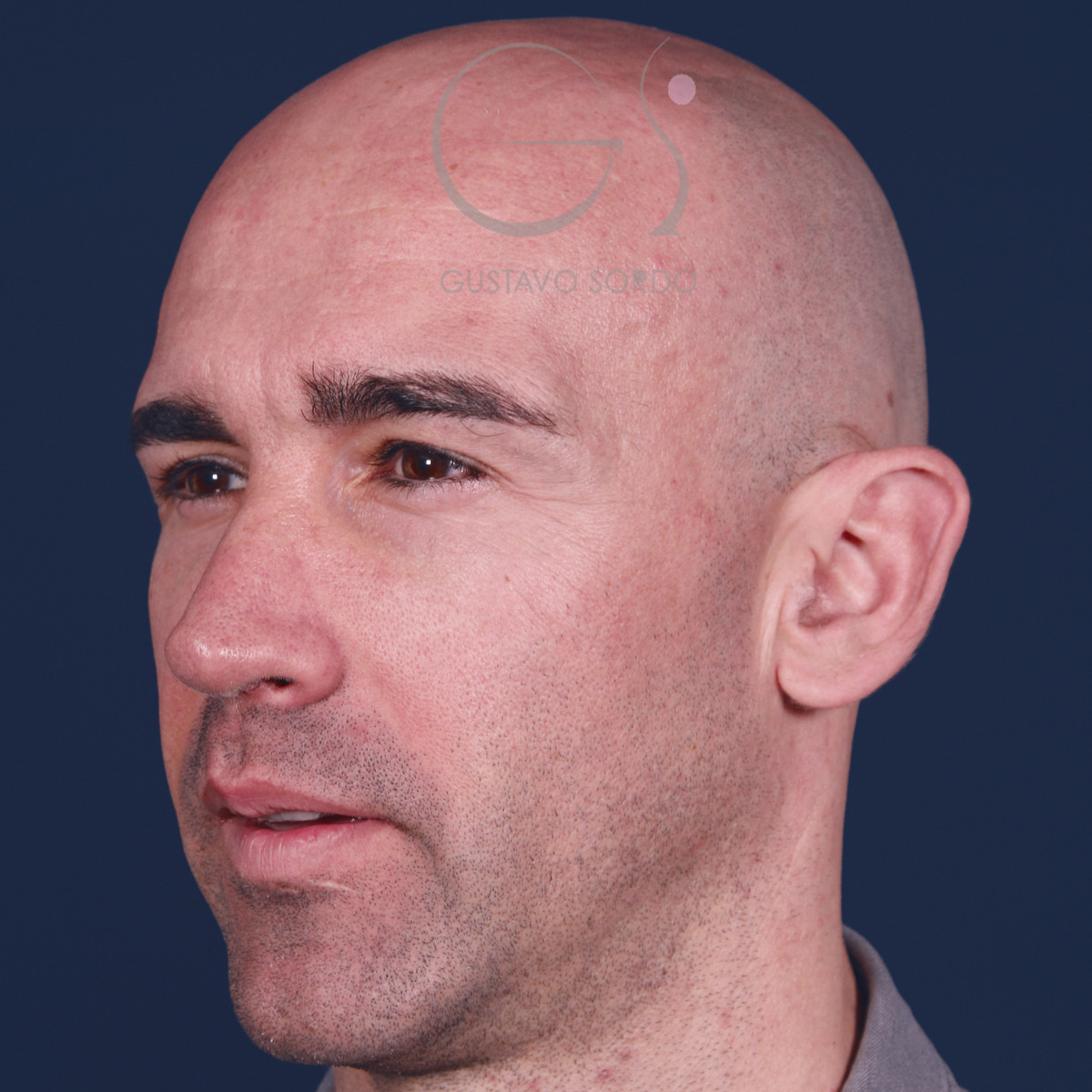 Rinoplastia ultrasónica en hombre con septoplastia y turbinoplastia, semiperfil izquierdo, a los 6 meses de la operación