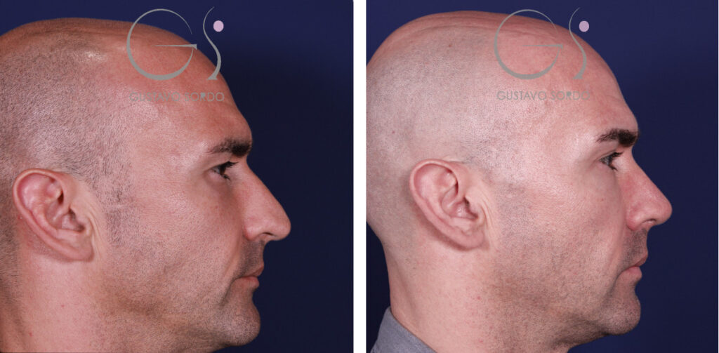Rinoplastia — en hombre: antes y después de un caso operado en Madrid