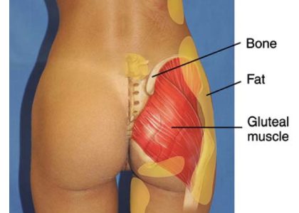 24.1-forma-gluteo