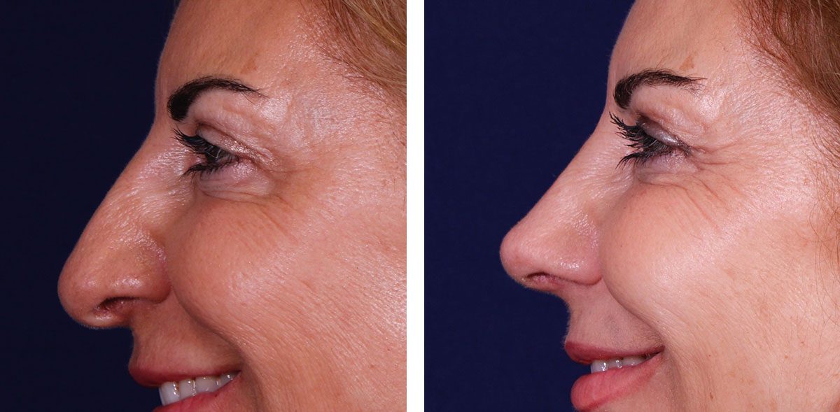 Nariz Rota Antes Y Despues Postoperatorio De La Cirugía De La Nariz