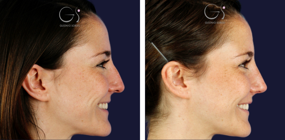 5-correccion-tabique-desviado-rinoplastia-ultrasonica-1536x753 (1)