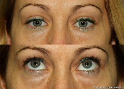 8.1-blefaroplastia