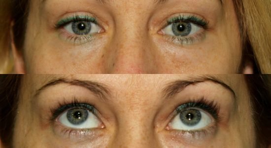 8.1-blefaroplastia