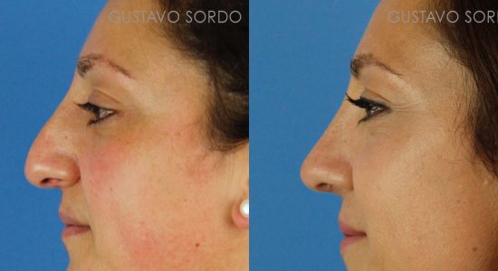 Rhinoplasty: Before and after profile of a case operated on by Dr. Gustavo Sordo in Madrid