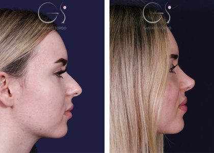 Nariz Respingada_ Guía Completa-fotoportada