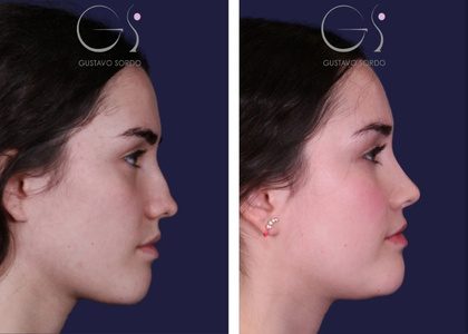 Nariz de boxeador_ Guía Completa-fotoportada