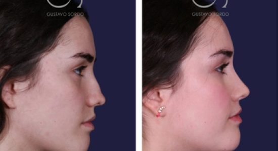 Rinoplastia en Madrid