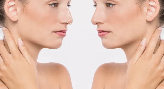 Rinoplastia en Madrid
