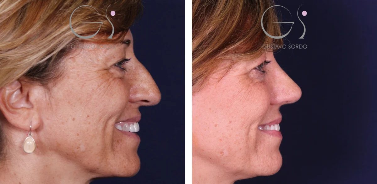 Rinoseptoplastia-1-1