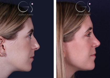 Rinoseptoplastia_ Todo lo que Necesitas Saber-portada