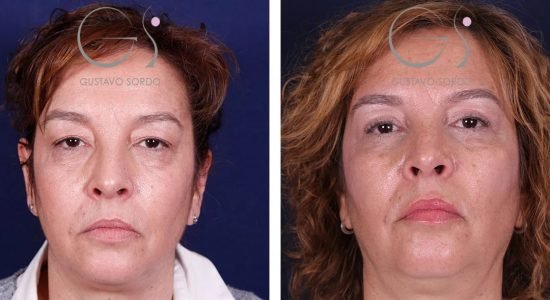 Blefaroplastia: antes y después de un caso operado en Madrid