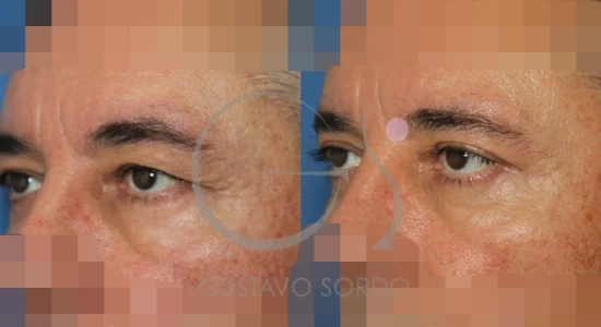 antes-despues-blefaroplastia-superior
