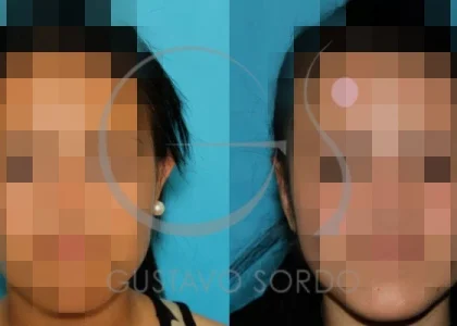 antes-despues-otoplastia-mujer-25-ano