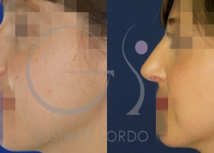 antes-despues-rinoplastia-mujer-31-anos