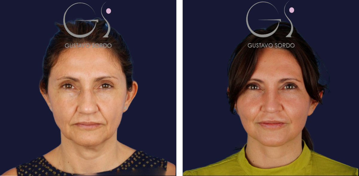 antes-y-despues-de-rinoplastia-y-lifting-facial-1536x756