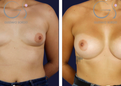 aumento-pecho-mamas-tuberosas-375cc