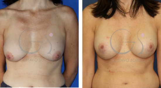 cambio-implantes-con-mastopexia