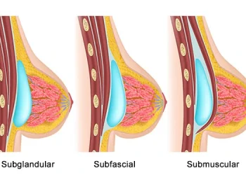 colocacion-implante-mamario