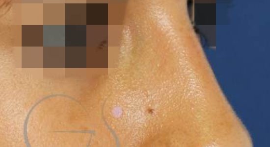 despues-resultados-rinoplastia-ultrasonica