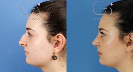 Rinoplastia ultrasónica en un dorso en S con giba marcada: perfil antes (izquierda) y después (derecha). Caso operado por el Dr. Gustavo Sordo en Madrid.