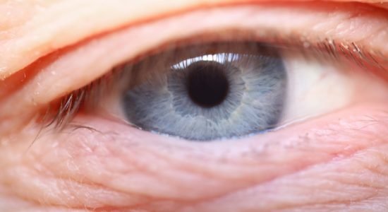 eliminar-parpados-caidos-blefaroplastia