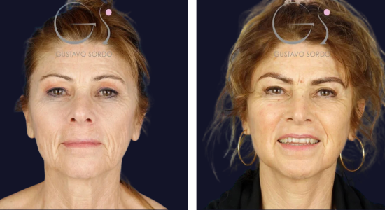 Blefaroplastia: antes y después de un caso operado en Madrid
