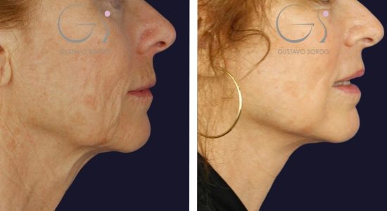 Lifting facial en Madrid