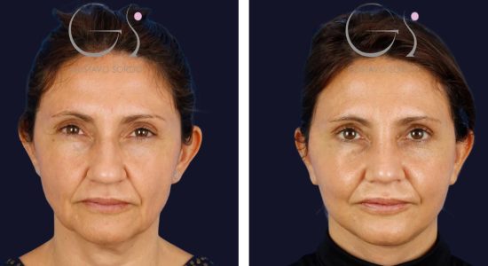 Lifting facial y rinoplastia: antes y después de un caso operado por el Dr. Gustavo Sordo en Madrid