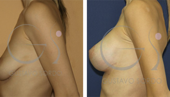 mastopexia-con-aumento-protesis-anatomicas