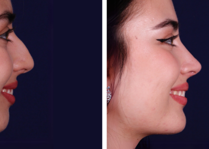 mentoplastia-correcc