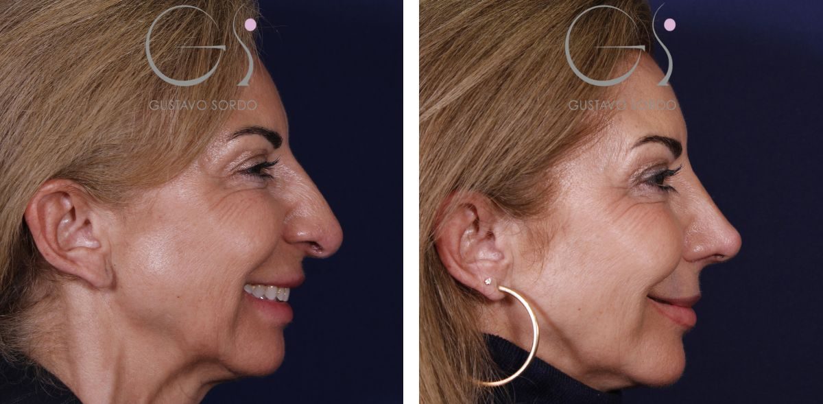 mentoplastia-rino-beatriz p