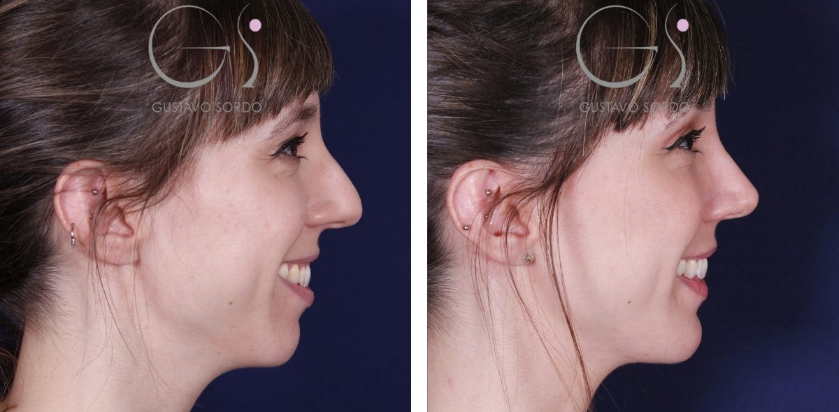 Rhinoplastie et mentoplastie : avant et après une intervention réalisée par le Dr Gustavo Sordo à Madrid