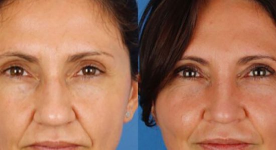 Rinoplastia — nariz ancha en Madrid