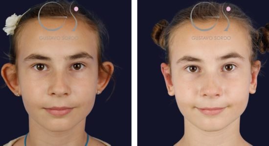 Otoplastia niña infantil: antes y después de un caso operado en Madrid