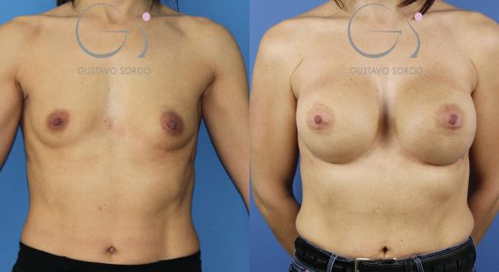 Aumento de pecho con implantes anatómicos de 545 cc en una paciente con pectus excavatum: antes (izquierda) y después (derecha). Caso operado por el Dr. Gustavo Sordo en Madrid.