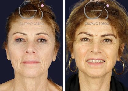 portada-blog-lifting-facial