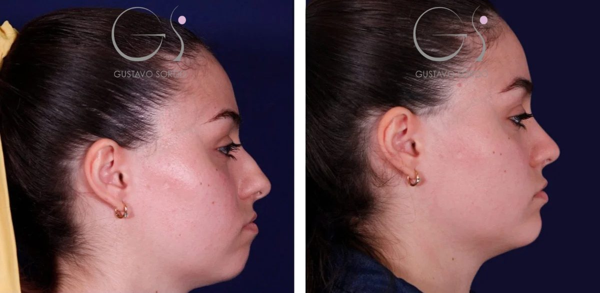 portada-rino-con-mentoplastia-r