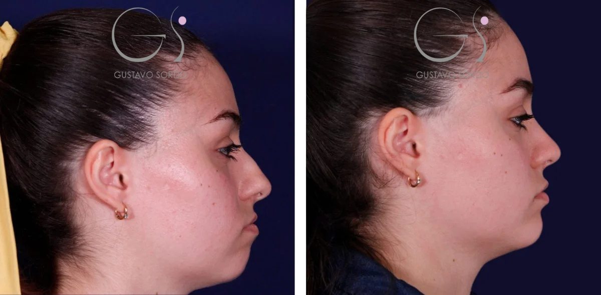 portada-rino-con-mentoplastia-r