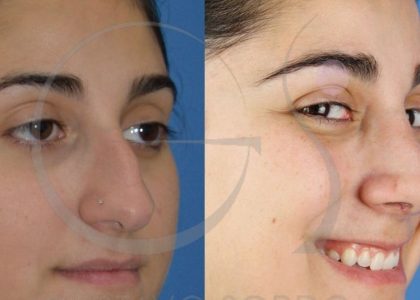 postoperatorio-rinoplastia-ultrasonica-recuperacion