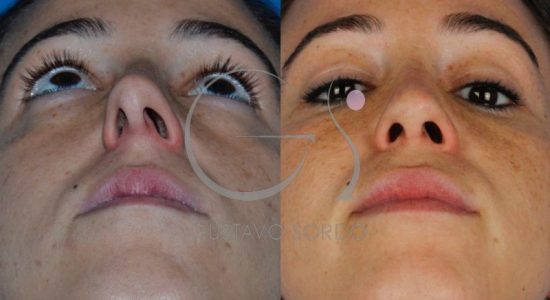 trouble-breathing-and-i-don't-like-my-nose