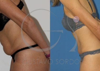 que-se-siente-despues-de-abdominoplastia