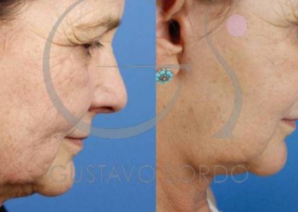 rejuvenecimiento-facial-lifting-frontal-cervicofacial-antes-despues