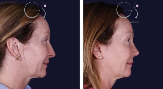 Rinoplastia — reducción de cornetes: antes y después de un caso operado en Madrid