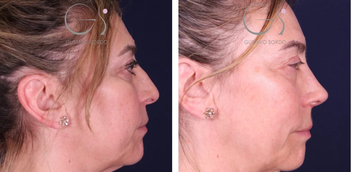Rinoplastia: antes y después de un caso operado en Madrid