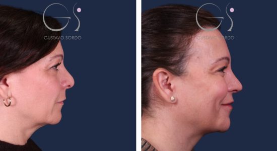 Rhinoplasty — bulbous nose: before and after a case operated on in Madrid