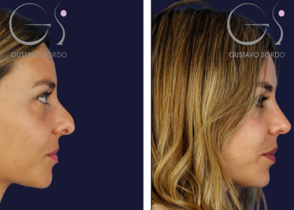rinoplastia-caballete-04