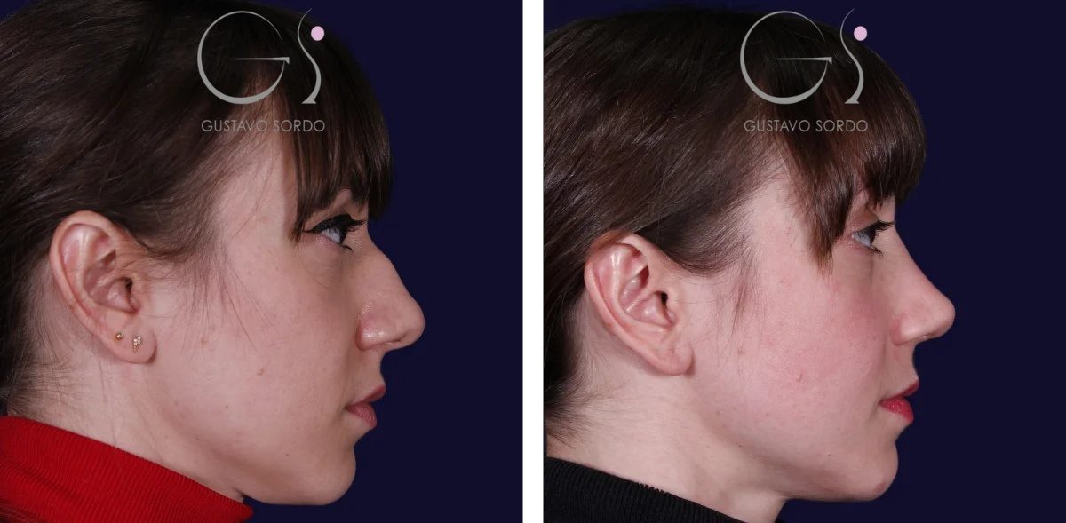 Rhinoplastie, cas n° 003