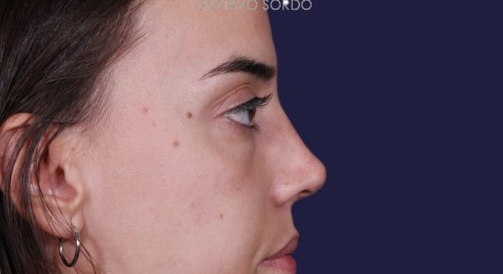 Rinoplastia en Madrid